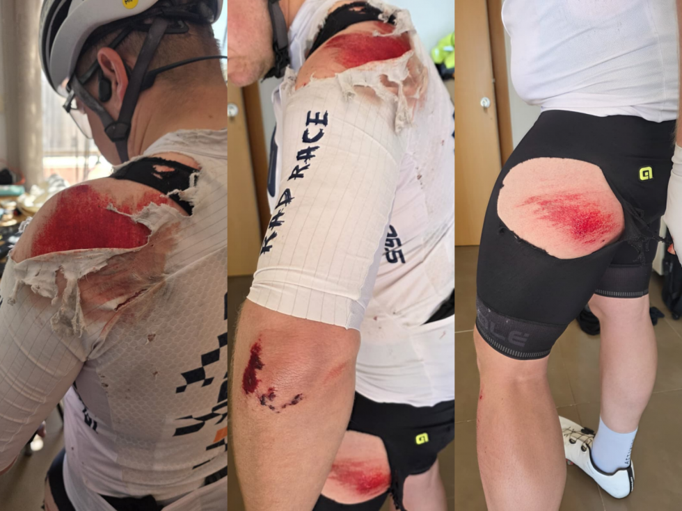 El afectado presenta abrasiones en brazo, hombro y pierna tras el accidente.